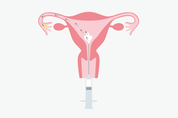 人工授精イメージ