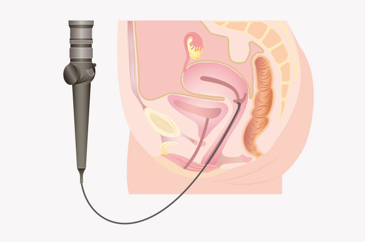 子宮鏡検査イメージ