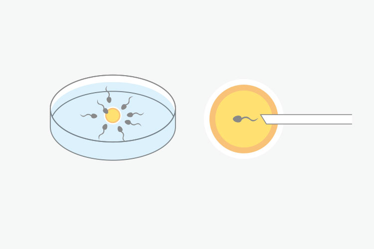 体外受精イメージ
